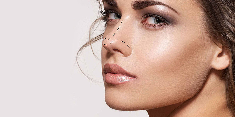 My experience with rhinoplasty without surgery